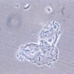 Cellules indicatrices, ou clue cells, observées au microscope dans une vaginose bactérienne