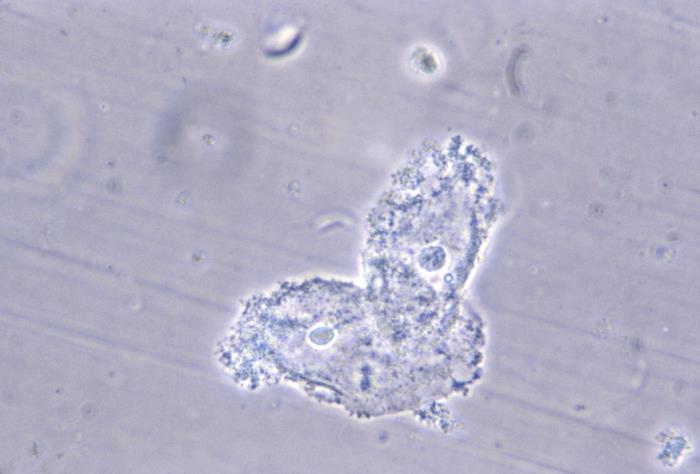 Cellules indicatrices, ou clue cells, observées au microscope dans une vaginose bactérienne