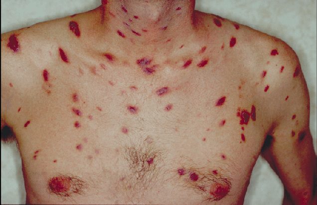 La maladie de Kaposi