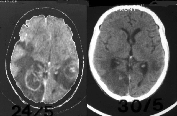 Toxoplasmose cérébrale
