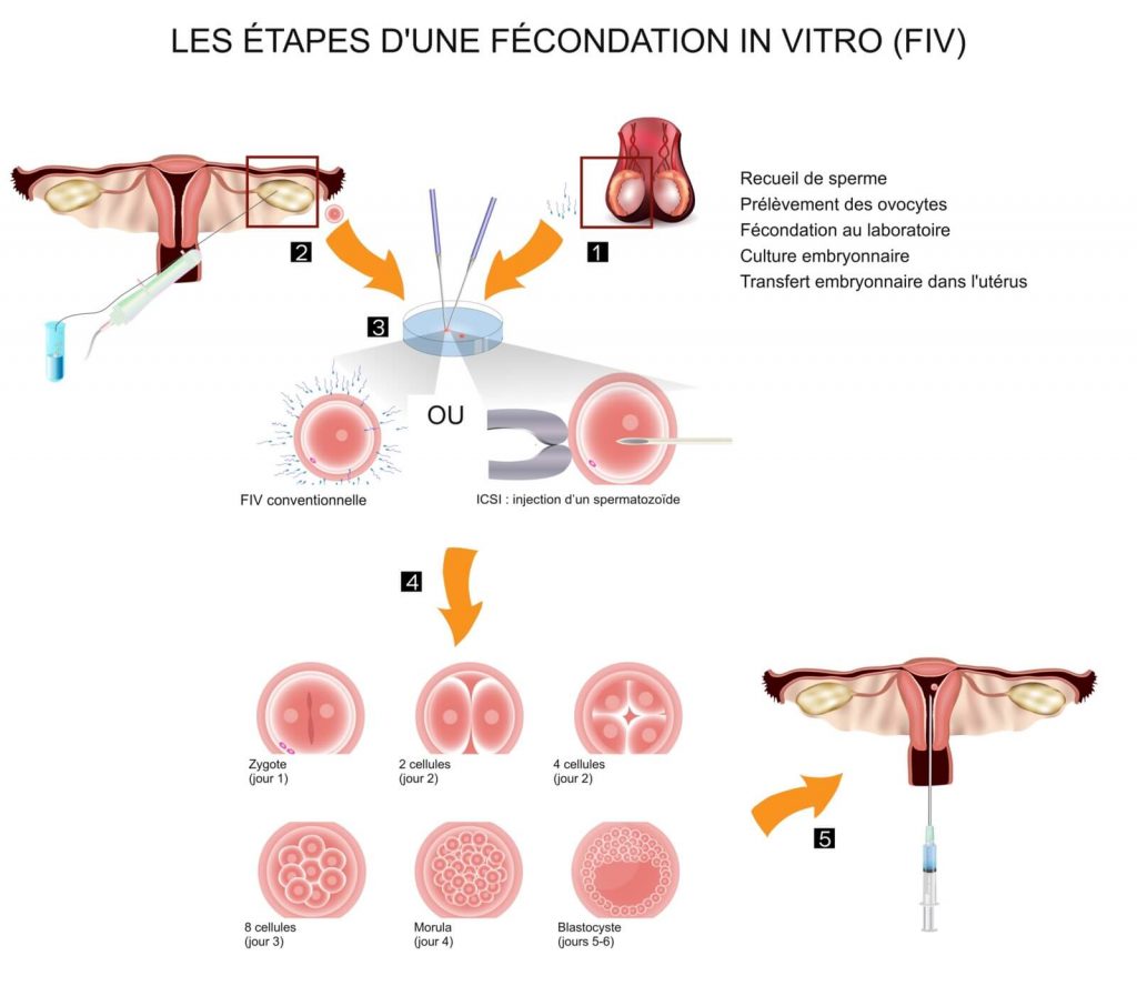 Schéma des étapes d’une fécondation in vitro, du recueil des gamètes au transfert embryonnaire