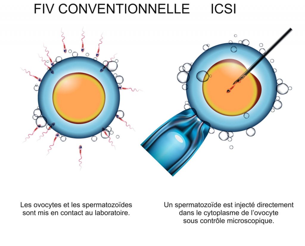 Comparaison entre fécondation in vitro conventionnelle et injection intracytoplasmique d’un spermatozoïde dans l’ovocyte