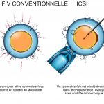Comparaison entre fécondation in vitro conventionnelle et injection intracytoplasmique d’un spermatozoïde dans l’ovocyte