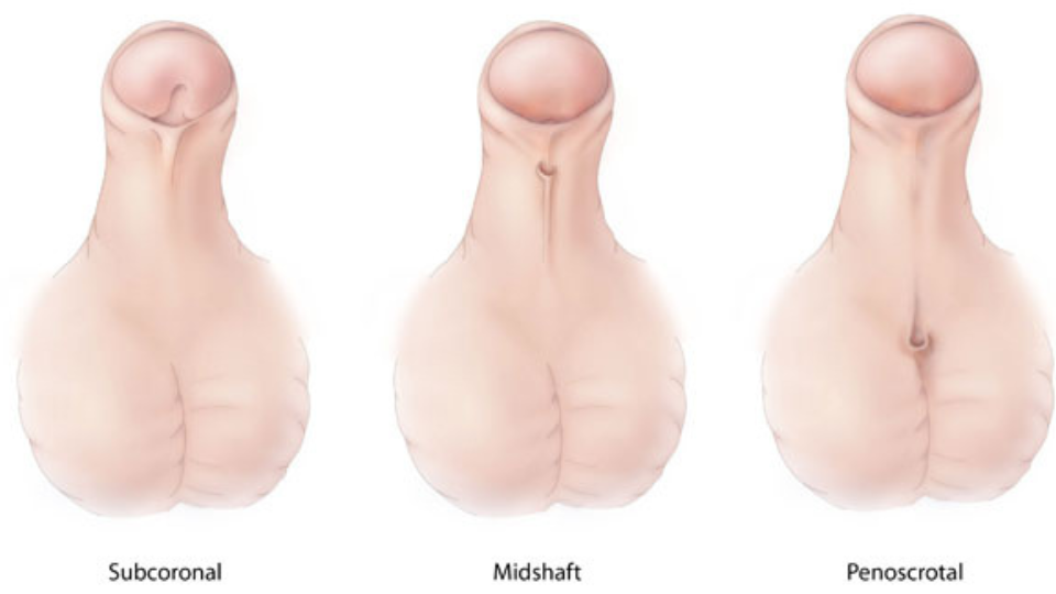 Schéma médical montrant trois types d’hypospade : subcoronal, pénien moyen et pénoscrotal