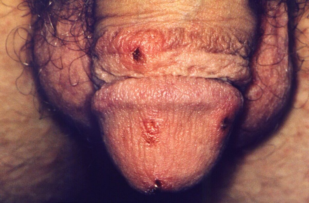 Lésions érosives et inflammatoires du gland et du prépuce liées à la gale