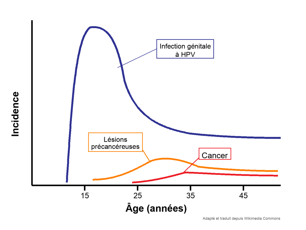 Graphique schématique en français montrant l’incidence de l’infection génitale à HPV, des lésions précancéreuses et du cancer selon l’âge.