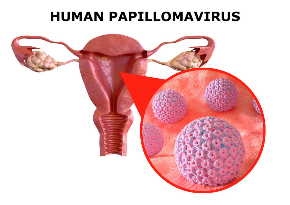 papillomavírus hpv femme)