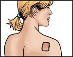 patch-contraceptif-evra