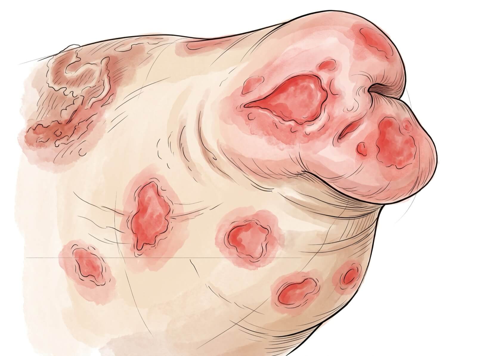 Illustration médicale de lésions génitales de syphilis secondaire.