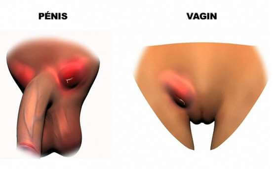 ulcerations lymphogranulomatose venerienne